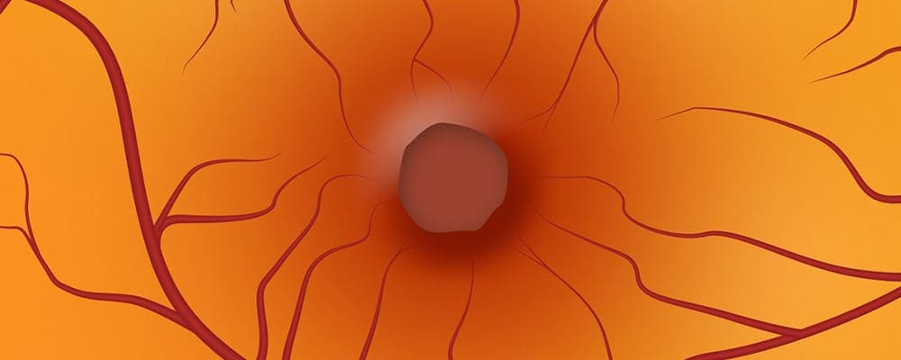 trou maculaire est ce grave symptomes oeil chirurgien ophtalmologue specialiste retine centre ophtalmologiste ophtalmologie paris est trou maculaire est ce grave symptomes oeil chirurgien ophtalmologue specialiste retine centre ophtalmologiste ophtalmologie paris est