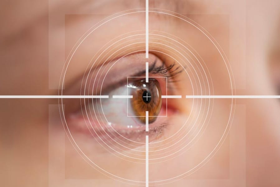 operation pkr ratee recuperation chirurgie refractive oeil ophtalmologie chirurgien ophtalmologue centre ophtalmologiste ophtalmologie paris est