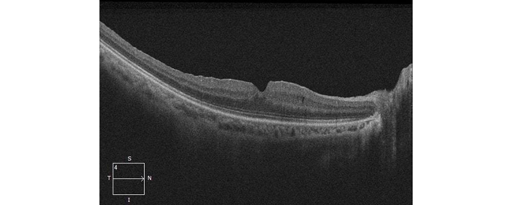 apres traitement tomographie en coherence optique membrane epi retinienne chirurgien ophtalmologue specialiste de la retine centre ophtalmologiste ophtalmologie paris est