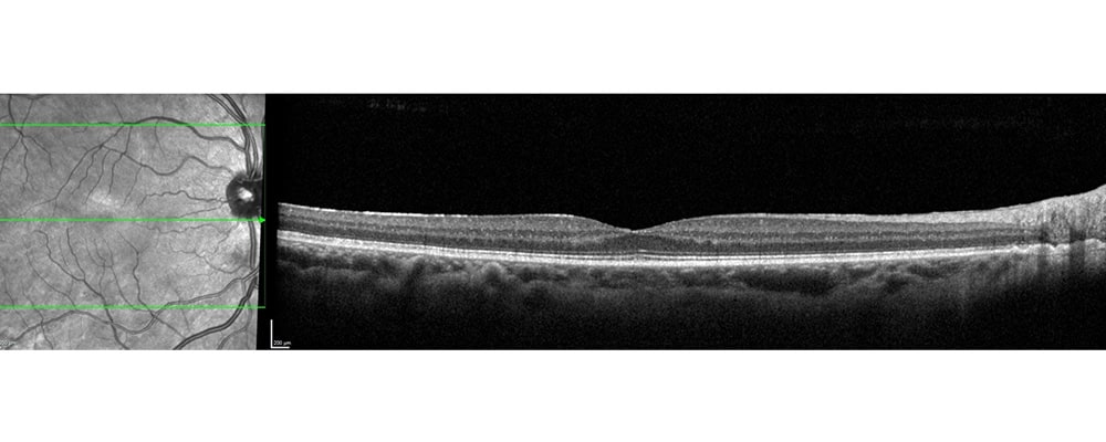 apres vitrectomie hematome pre retinien syndrome de terson chirurgien ophtalmologue specialiste de la retine centre ophtalmologiste ophtalmologie paris est