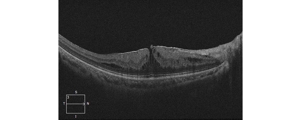 avant traitement tomographie en coherence optique membrane epi retinienne chirurgien ophtalmologue specialiste de la retine centre ophtalmologiste ophtalmologie paris est