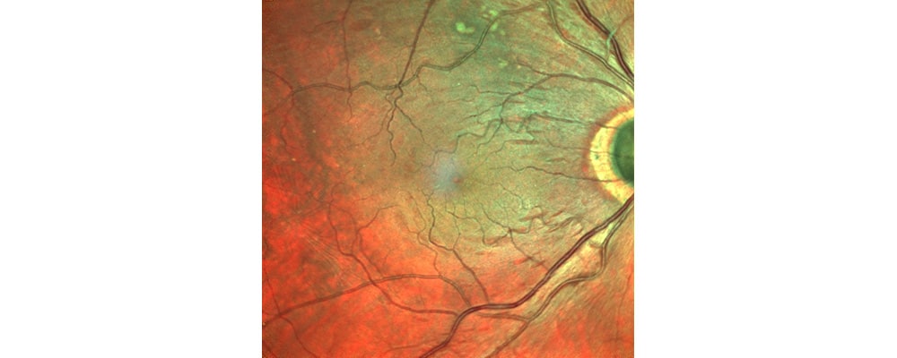 chirurgien ophtalmologue specialiste retine centre ophtalmologiste ophtalmologie paris est