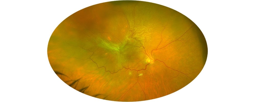 decollement de la retine que faire rhegmatogene chirurgien ophtalmologue specialiste retine centre ophtalmologiste ophtalmologie paris est