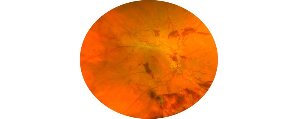 decollement de la retine tractionel chirurgien ophtalmologue specialiste de la retine centre ophtalmologiste ophtalmologie paris est