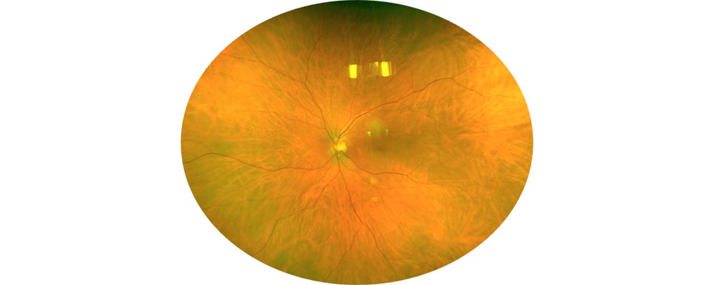 decollement de retine apres traitement vitrectomie chirurgien ophtalmologue specialiste de la retine centre ophtalmologiste ophtalmologie paris est 2