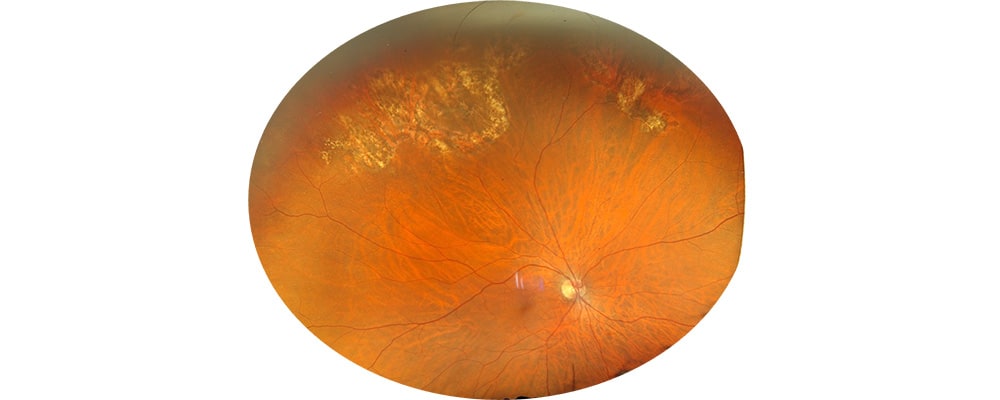 decollement de retine apres traitement vitrectomie chirurgien ophtalmologue specialiste de la retine centre ophtalmologiste ophtalmologie paris est 3