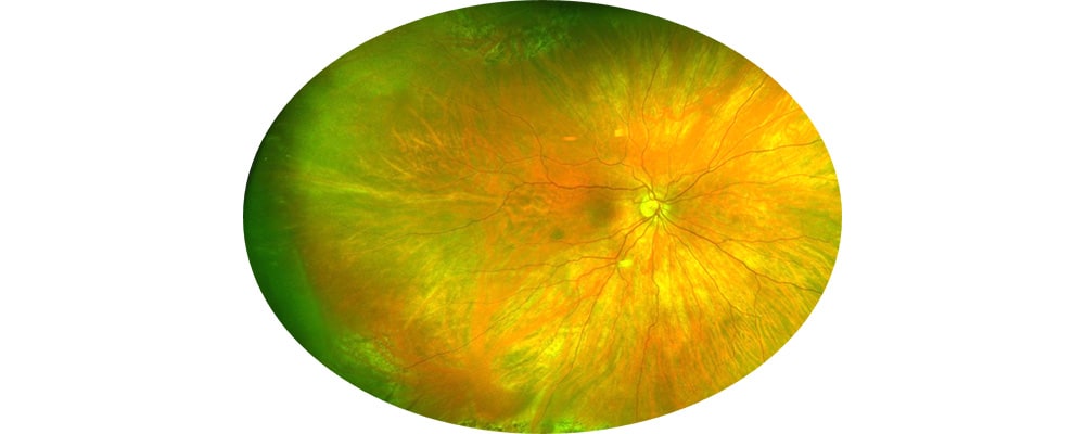 decollement de retine apres traitement vitrectomie chirurgien ophtalmologue specialiste de la retine centre ophtalmologiste ophtalmologie paris est 4