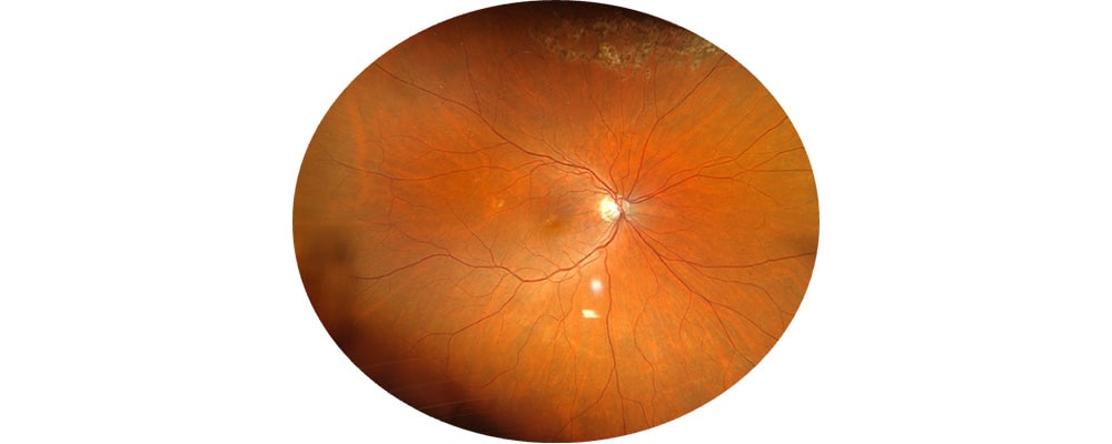 decollement de retine apres traitement vitrectomie chirurgien ophtalmologue specialiste de la retine centre ophtalmologiste ophtalmologie paris est