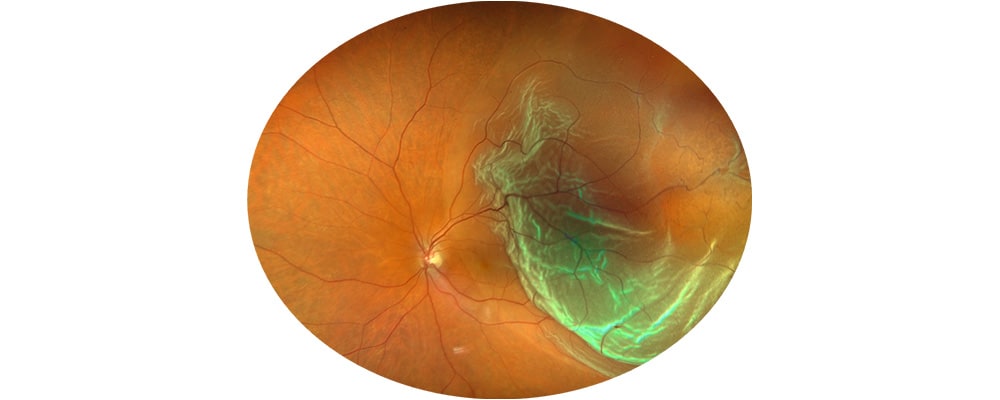 decollement de retine avant traitement vitrectomie chirurgien ophtalmologue specialiste de la retine centre ophtalmologiste ophtalmologie paris est 2