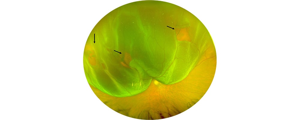 decollement de retine avant traitement vitrectomie chirurgien ophtalmologue specialiste de la retine centre ophtalmologiste ophtalmologie paris est 3