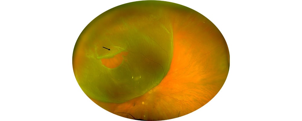 decollement de retine avant traitement vitrectomie chirurgien ophtalmologue specialiste de la retine centre ophtalmologiste ophtalmologie paris est 4