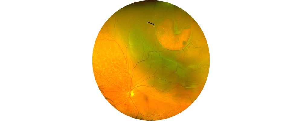 decollement de retine avant traitement vitrectomie chirurgien ophtalmologue specialiste de la retine centre ophtalmologiste ophtalmologie paris est 5