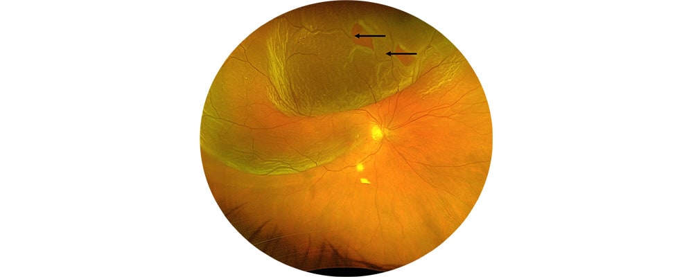 decollement de retine avant traitement vitrectomie chirurgien ophtalmologue specialiste de la retine centre ophtalmologiste ophtalmologie paris est