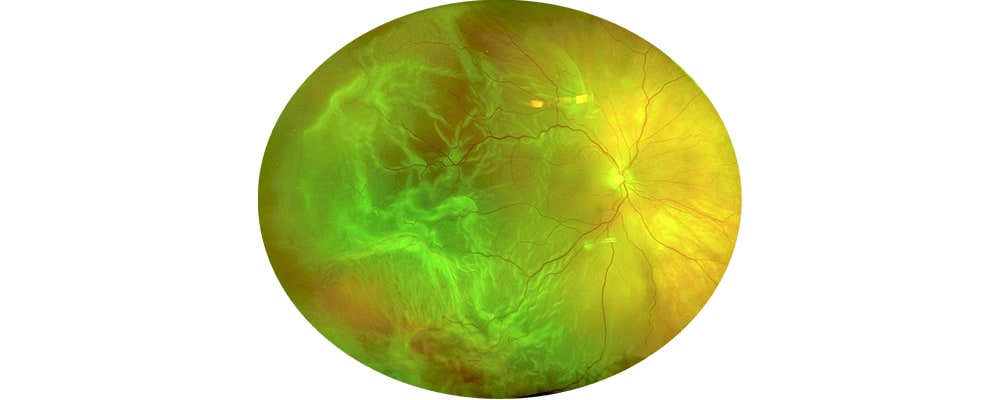 decollement de retine complique de pvr chirurgien ophtalmologue specialiste de la retine centre ophtalmologiste ophtalmologie paris est