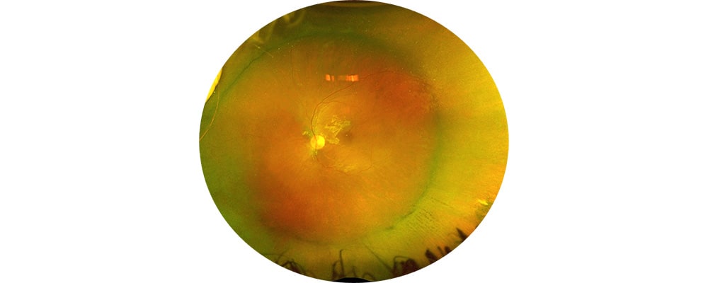 decollement de retine inferieure sans dechirure identifiee chirurgien ophtalmologue specialiste retine centre ophtalmologiste ophtalmologie paris est