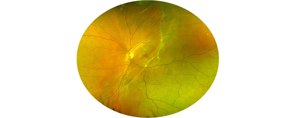 decollement de retine infero temporale chronique chirurgien ophtalmologue specialiste retine centre ophtalmologiste ophtalmologie paris est 1