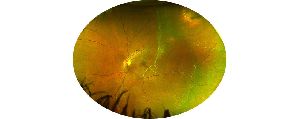 decollement de retine infero temporale chronique chirurgien ophtalmologue specialiste retine centre ophtalmologiste ophtalmologie paris est