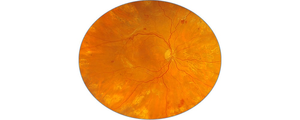 decollement de retine tractionel traitement vitrectomie chirurgien ophtalmologue specialiste de la retine centre ophtalmologiste ophtalmologie paris est