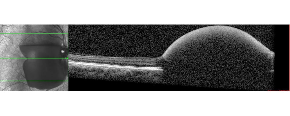 hematome pre retinien syndrome de terson chirurgien ophtalmologue specialiste de la retine centre ophtalmologiste ophtalmologie paris est