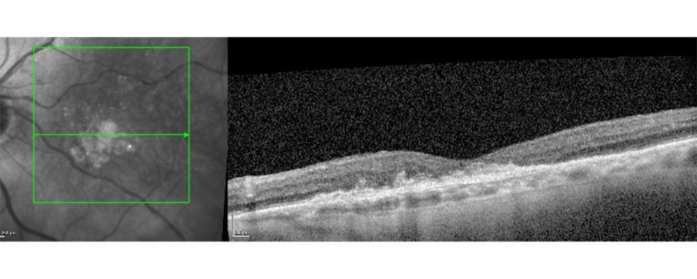 hematome retine dmla chirurgien ophtalmologue specialiste de la retine centre ophtalmologiste ophtalmologie paris est