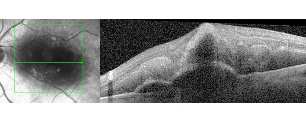 hematome retinien sur dmla chirurgien ophtalmologue specialiste de la retine centre ophtalmologiste ophtalmologie paris est