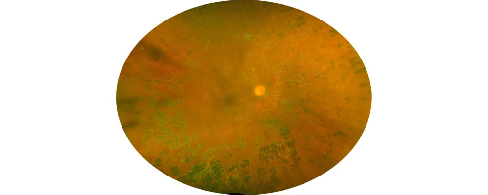 hemorragie intra vitreenne chirurgien ophtalmologue specialiste retine centre ophtalmologiste ophtalmologie paris est