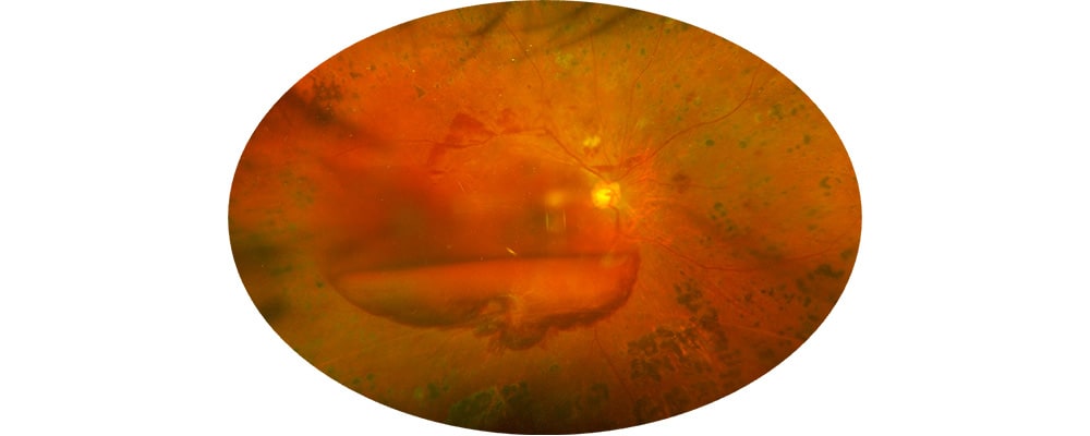 hemorragie intra vitreenne traitement chirurgien ophtalmologue specialiste retine centre ophtalmologiste ophtalmologie paris est