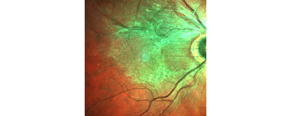 membrane epi retinienne chirurgien ophtalmologue specialiste retine centre ophtalmologiste ophtalmologie paris est