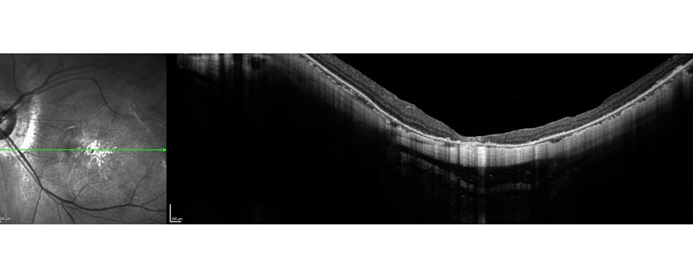 myope forte monophtalme definition trou maculaire traitement chirurgien ophtalmologue specialiste retine centre ophtalmologiste ophtalmologie paris est