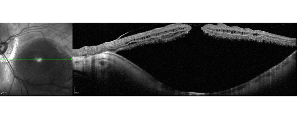 myope forte operation monophtalme trou maculaire chirurgien ophtalmologue specialiste retine centre ophtalmologiste ophtalmologie paris est