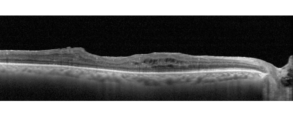 occlusion de la veine centrale de la retine traitement chirurgien ophtalmologue specialiste de la retine centre ophtalmologiste ophtalmologie paris est