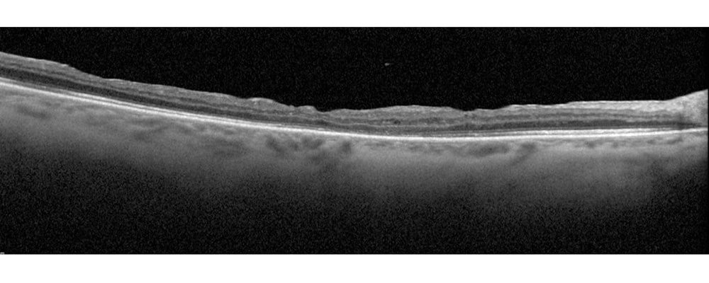 oct vitrectomie decollement de retine complique de pvr chirurgien ophtalmologue specialiste de la retine centre ophtalmologiste ophtalmologie paris est