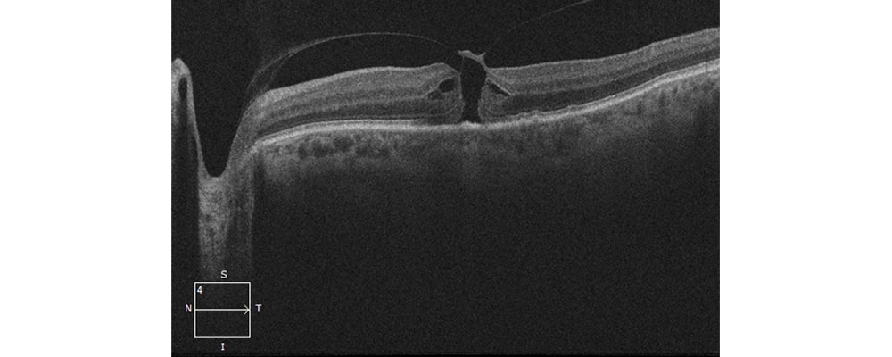 symptomes trou maculaire oeil tomographie en coherence optique chirurgien ophtalmologue specialiste retine centre ophtalmologiste ophtalmologie paris est