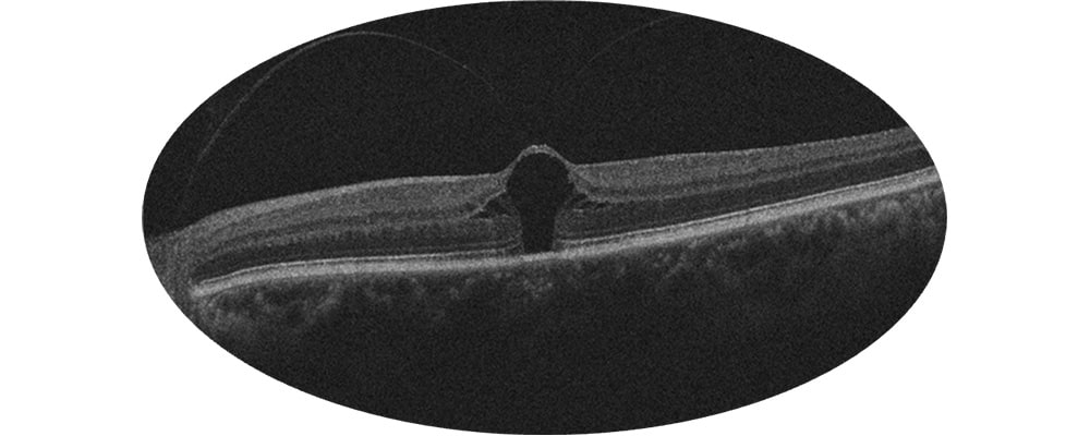 syndrome de traction vitreo maculaire tomographie en coherence optique chirurgien ophtalmologue specialiste retine centre ophtalmologiste ophtalmologie paris est