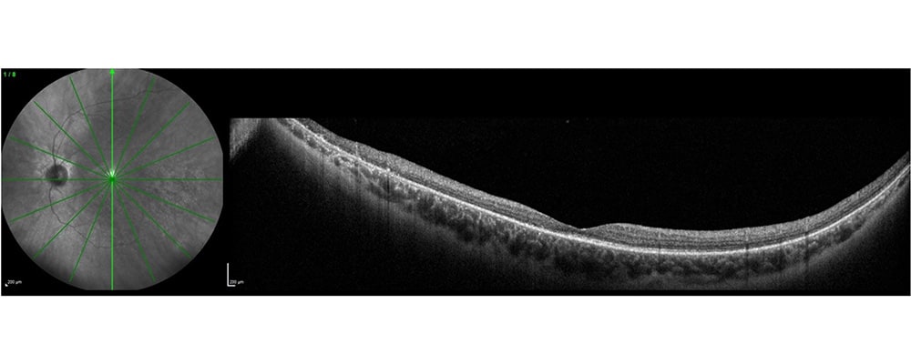 tomographie en coherence optique decollement de retine inferieure sans dechirure identifiee chirurgien ophtalmologue specialiste retine centre ophtalmologiste ophtalmologie paris est 1