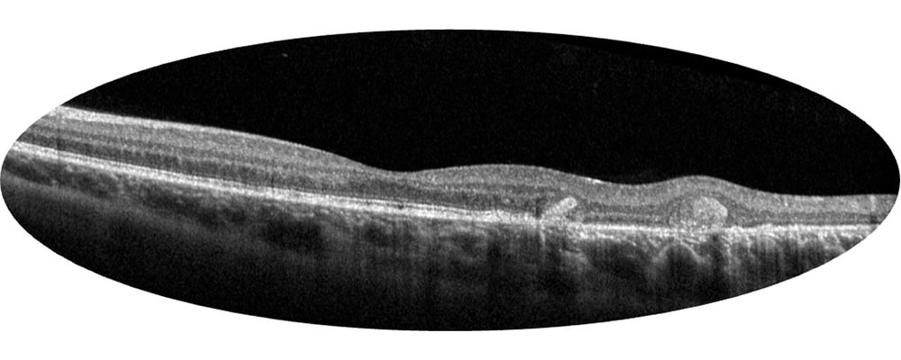 tomographie en coherence optique decollement de retine infero temporale chronique chirurgien ophtalmologue specialiste de la retine centre ophtalmologiste ophtalmologie paris est 1
