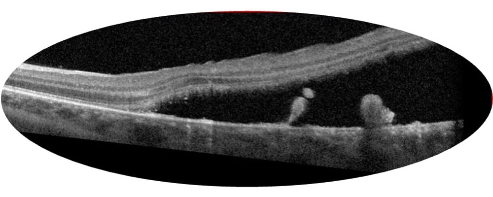 tomographie en coherence optique decollement de retine infero temporale chronique chirurgien ophtalmologue specialiste de la retine centre ophtalmologiste ophtalmologie paris est