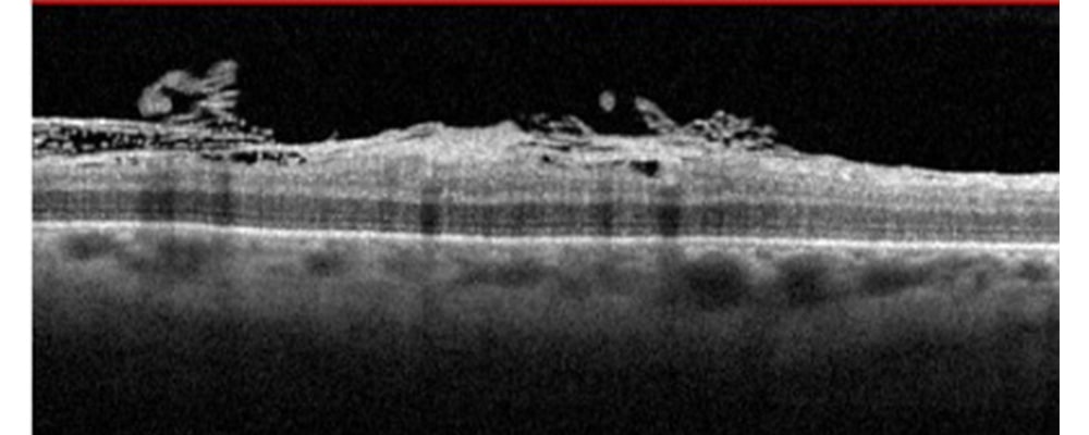 tomographie en coherence optique membrane epi retinienne chirurgien ophtalmologue specialiste de la retine centre ophtalmologiste ophtalmologie paris est