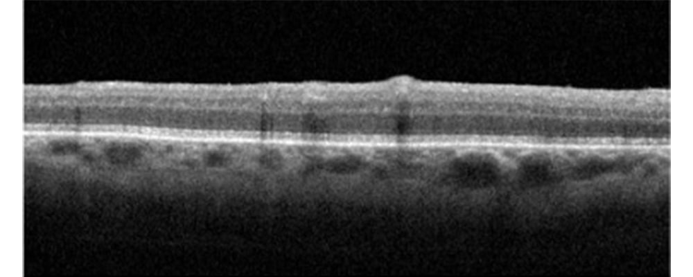 tomographie en coherence optique membrane epi retinienne traitement chirurgien ophtalmologue specialiste de la retine centre ophtalmologiste ophtalmologie paris est
