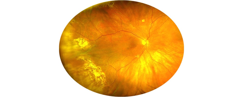 traitement decollement de retine complique de pvr chirurgien ophtalmologue specialiste de la retine centre ophtalmologiste ophtalmologie paris est