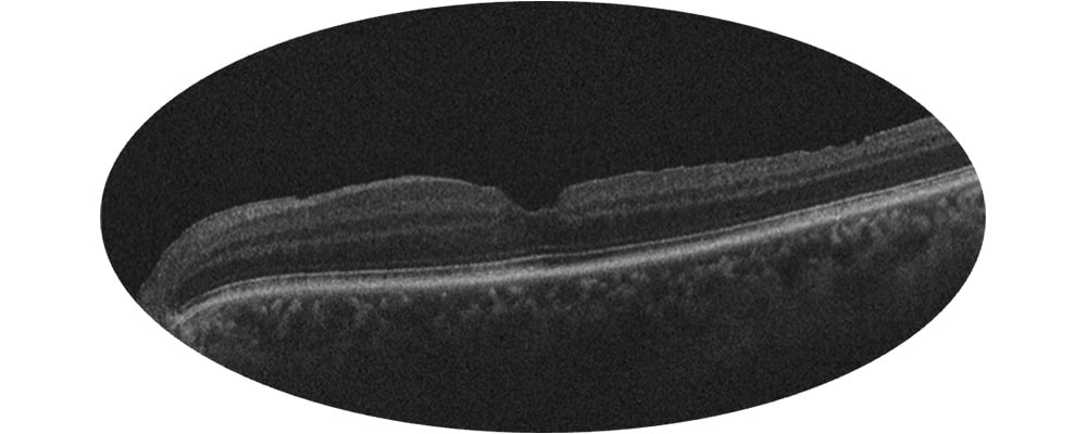 traitement syndrome de traction vitreo maculaire tomographie en coherence optique chirurgien ophtalmologue specialiste retine centre ophtalmologiste ophtalmologie paris est