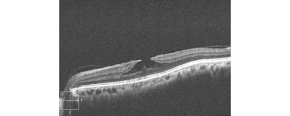 trou lamellaire maculaire oeil chirurgien ophtalmologue specialiste de la retine centre ophtalmologiste ophtalmologie paris est