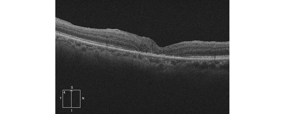 trou maculaire convalescence apres operation tomographie en coherence optique chirurgien ophtalmologue specialiste retine centre ophtalmologiste ophtalmologie paris est