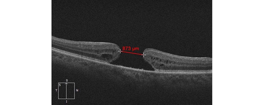 trou maculaire est ce grave tomographie en coherence optique chirurgien ophtalmologue specialiste retine centre ophtalmologiste ophtalmologie paris est