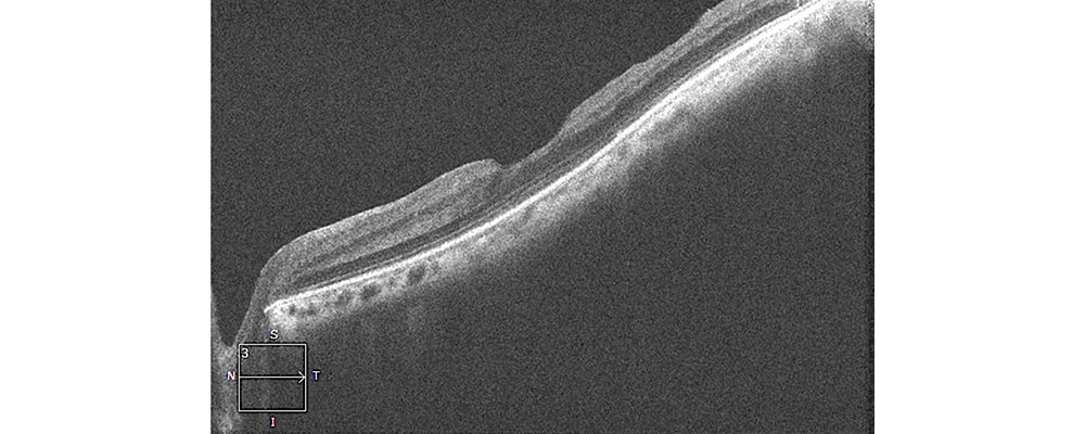 trou maculaire lamellaire traitement chirurgien ophtalmologue specialiste retine centre ophtalmologiste ophtalmologie paris est