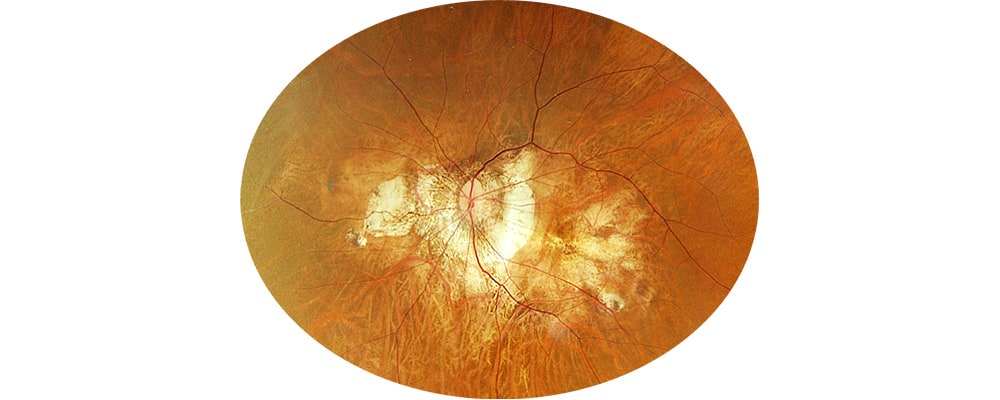 trou maculaire myopie forte chirurgien ophtalmologue specialiste retine centre ophtalmologiste ophtalmologie paris est