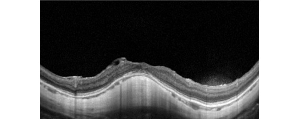 trou maculaire myopie forte traitement vitrectomie chirurgien ophtalmologue specialiste retine centre ophtalmologiste ophtalmologie paris est