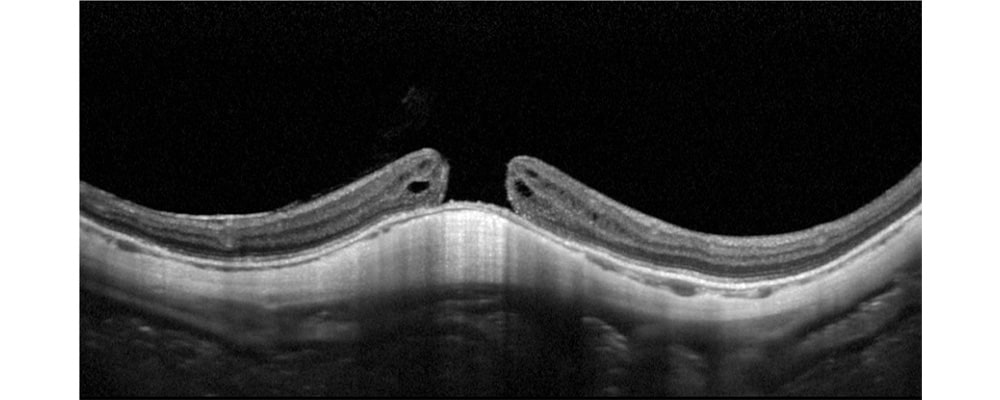 trou maculaire oeil myopie forte vitrectomie chirurgien ophtalmologue specialiste retine centre ophtalmologiste ophtalmologie paris est