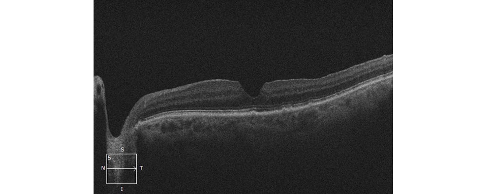 trou maculaire operation vitrectomie chirurgien ophtalmologue specialiste retine centre ophtalmologiste ophtalmologie paris est