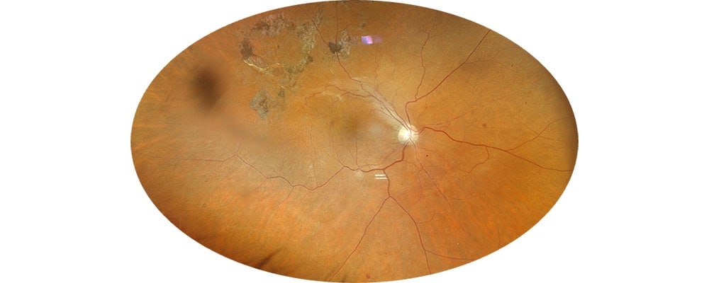 vitrectomie operation decollement de retine mixte chirurgien ophtalmologue specialiste de la retine centre ophtalmologiste ophtalmologie paris est